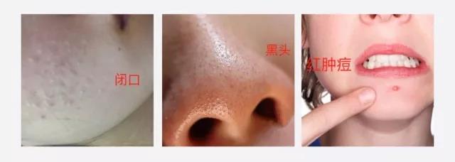 兰希黎：痘肌安利！痘痘再见，不要回来